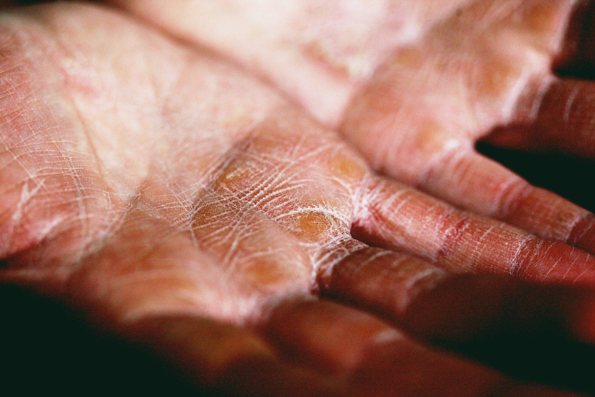 Eczema vs Psoriasis: What's the Difference?