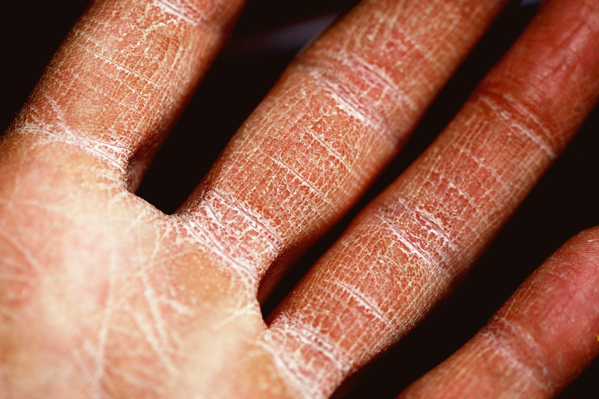 Goat Milk Soap for Dry, Cracked Hands: A Complete Guide