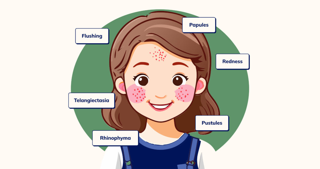 Illustration of a young girl showing the symptoms of rosacea (flushing, redness, papules, telangiectasia, rhinophyma)